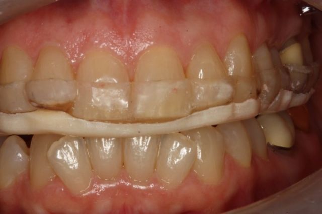 Bite Plane Braces: Price, Uses & More 3 - Bite Plane Braces: Price, Uses & More Bite Plane Braces: Price, Uses More