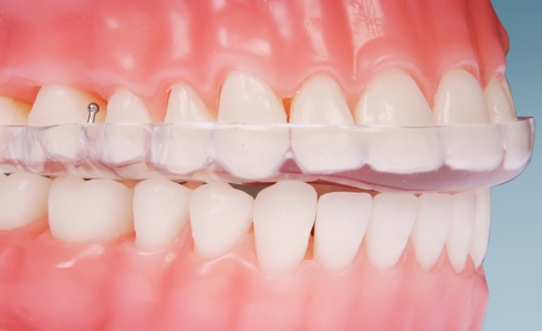 Bite Plane Braces: Price, Uses & More 4 - Bite Plane Braces: Price, Uses & More Bite Plane Braces: Price, Uses More