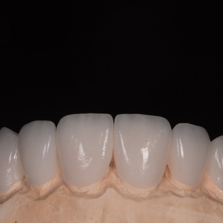 Feldspathic Veneers: The Ultimate Guide 5 - Feldspathic Veneers: The Ultimate Guide Feldspathic Veneers: The Ultimate Guide