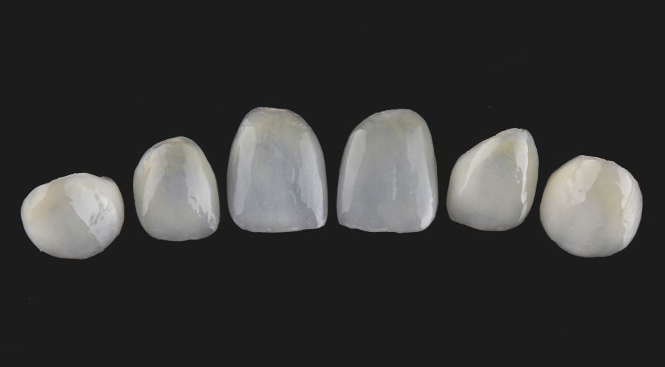 Feldspathic Veneers: The Ultimate Guide 8 - Feldspathic Veneers: The Ultimate Guide Feldspathic Veneers: The Ultimate Guide