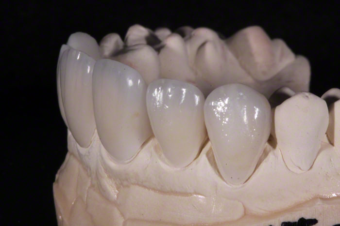 Feldspathic Veneers: The Ultimate Guide 2 - Feldspathic Veneers: The Ultimate Guide Feldspathic Veneers: The Ultimate Guide