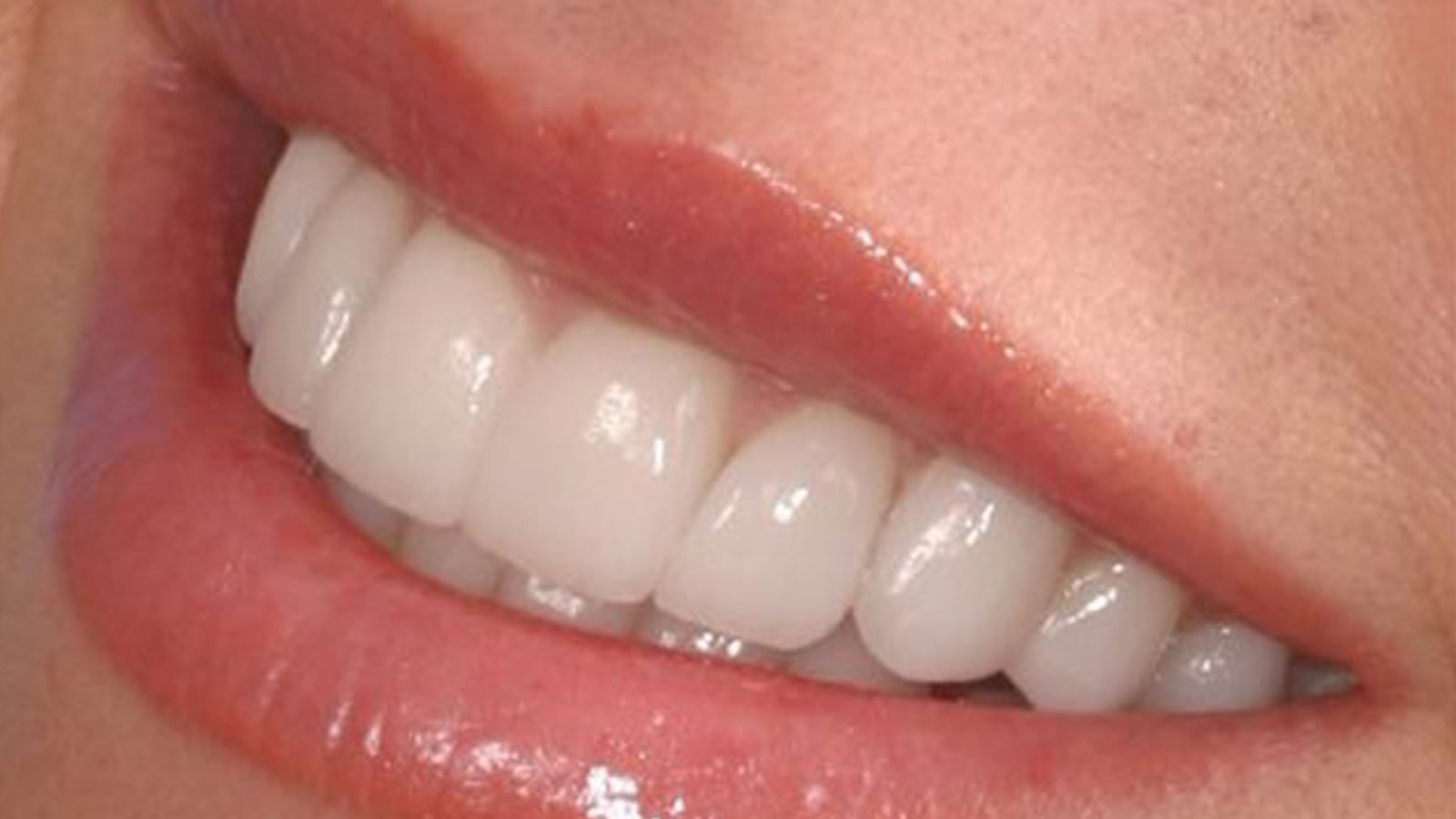Feldspathic Veneers: The Ultimate Guide 4 - Feldspathic Veneers: The Ultimate Guide Feldspathic Veneers: The Ultimate Guide