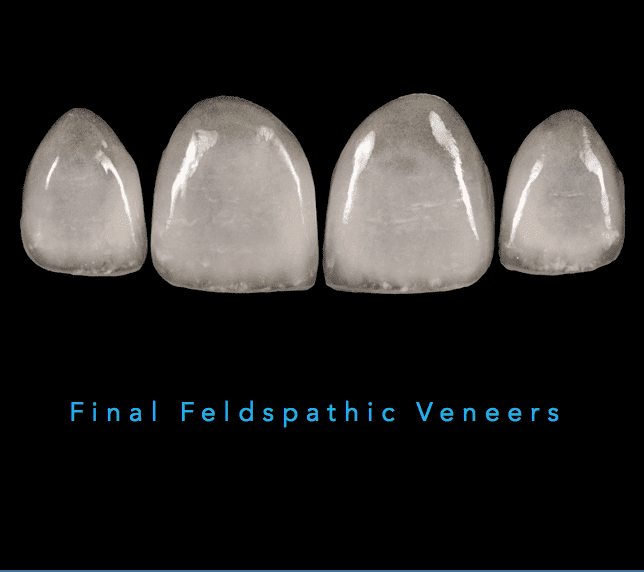 Feldspathic Veneers: The Ultimate Guide 7 - Feldspathic Veneers: The Ultimate Guide Feldspathic Veneers: The Ultimate Guide