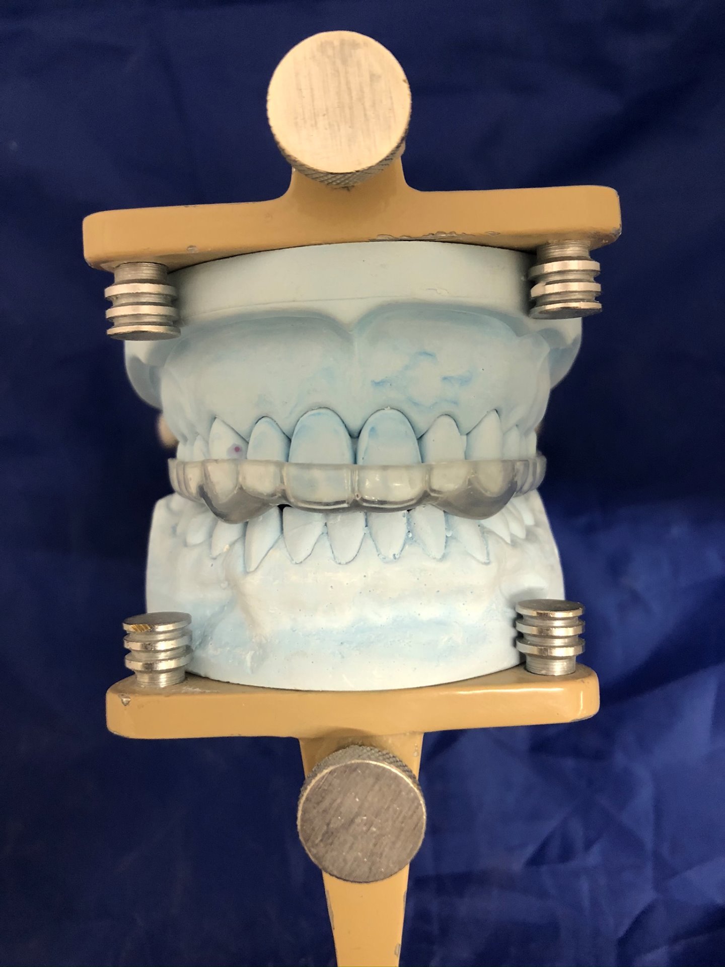 Michigan Splint: A Comprehensive Guide 3 - Michigan Splint: A Comprehensive Guide Michigan Splint: A Comprehensive Guide