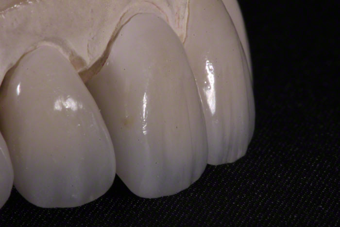 Feldspathic Veneers - A Comprehensive Guide to Material, Cost Procedure Feldspathic Veneers - A Comprehensive Guide to Material, Cost Procedure