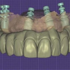 All on X CADCAM 2 - World Dental Lab - World Dental Lab