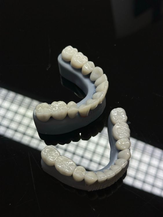 Dental Bridge on Cast Model — Types, Materials and Fabrication Dental bridge and prosthetic teeth on a dental cast — fixed restoration spanning a missing tooth gap