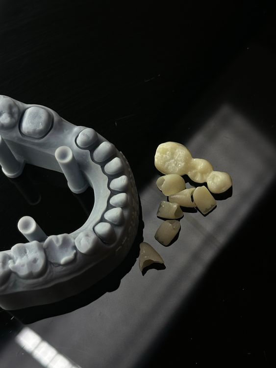 Dental Stone Cast on Articulator — Foundation for Diagnostic Wax-Up Planning Dental stone cast model on articulator for diagnostic wax-up and restoration planning — dental lab workflow