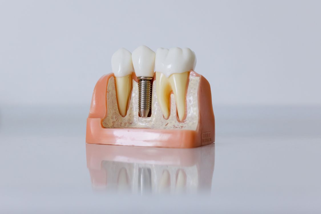 Dental implant crown restoration — showing the difference between an implant-supported and tooth-supported crown