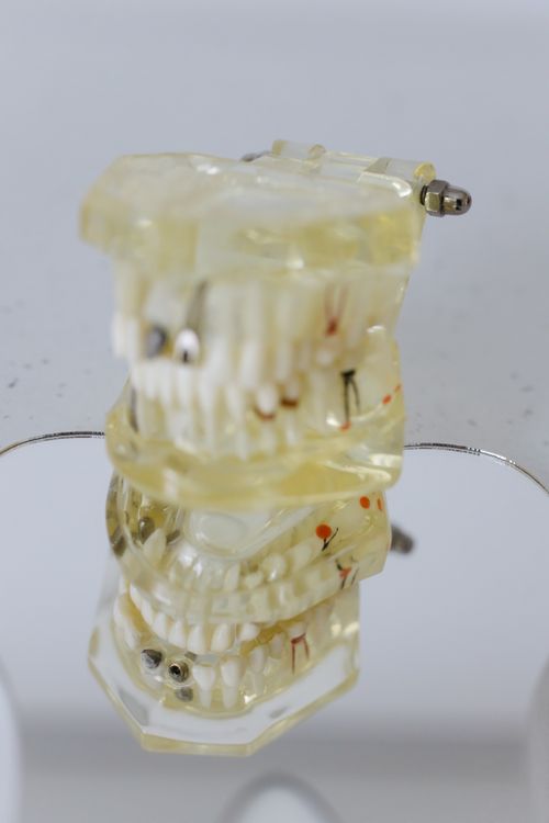 Dental implant full arch model showing implant posts in jawbone — implant-supported bridge foundation in dental lab