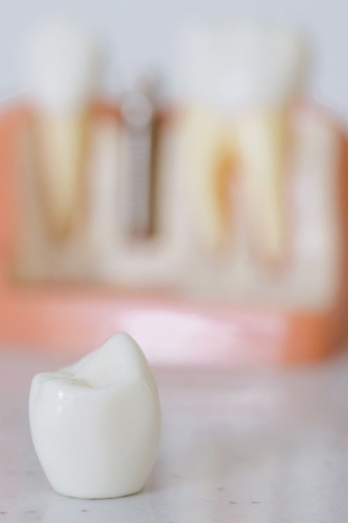 Dental implant abutment and screw-retained crown — components of a complete implant restoration