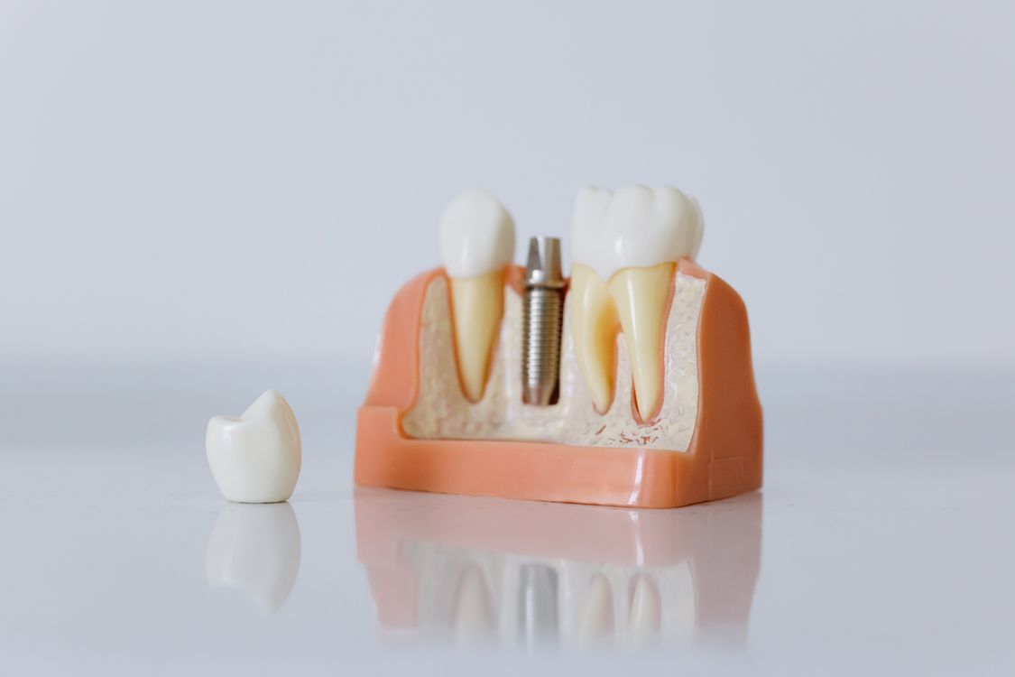 Dental implant abutment on model — implant-supported crown and bridge prosthetic attachment in lab