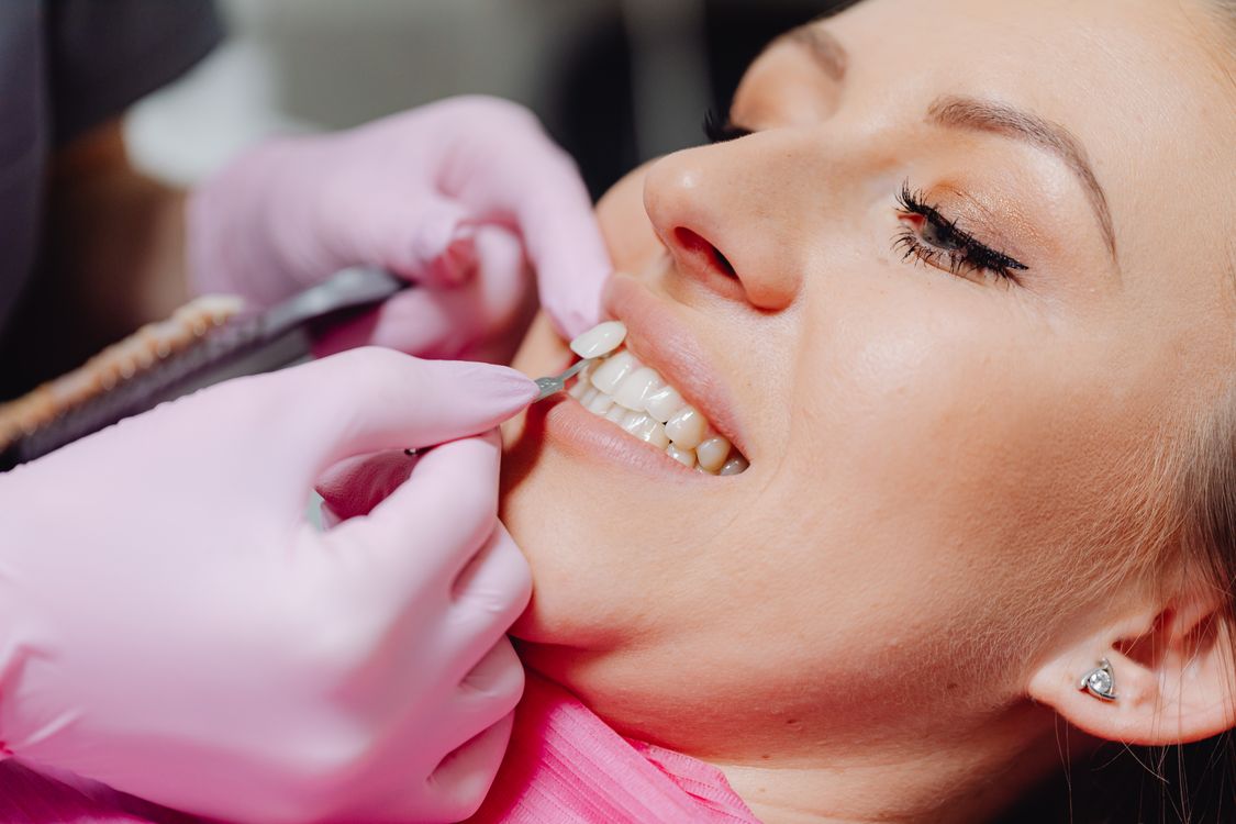 Porcelain dental veneers on teeth — thin ceramic shells bonded to front surface for smile makeover and aesthetic restoration