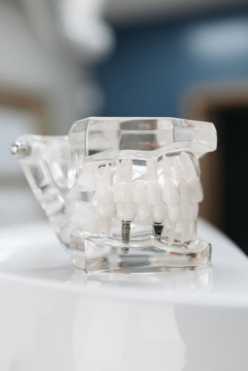 Full arch implant-supported bridge model showing prosthetic teeth on implant posts — All-on-4 and multi-unit bridge design
