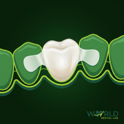 Zirconia Maryland Bridge (Layered)