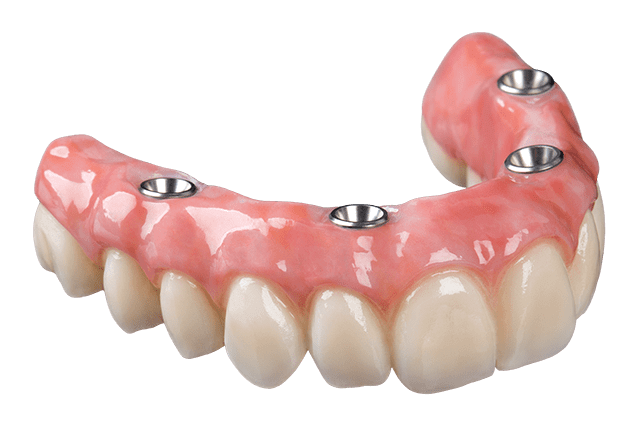 Full Arch Implant Restorations - Implant Dental Lab - World Dental Lab