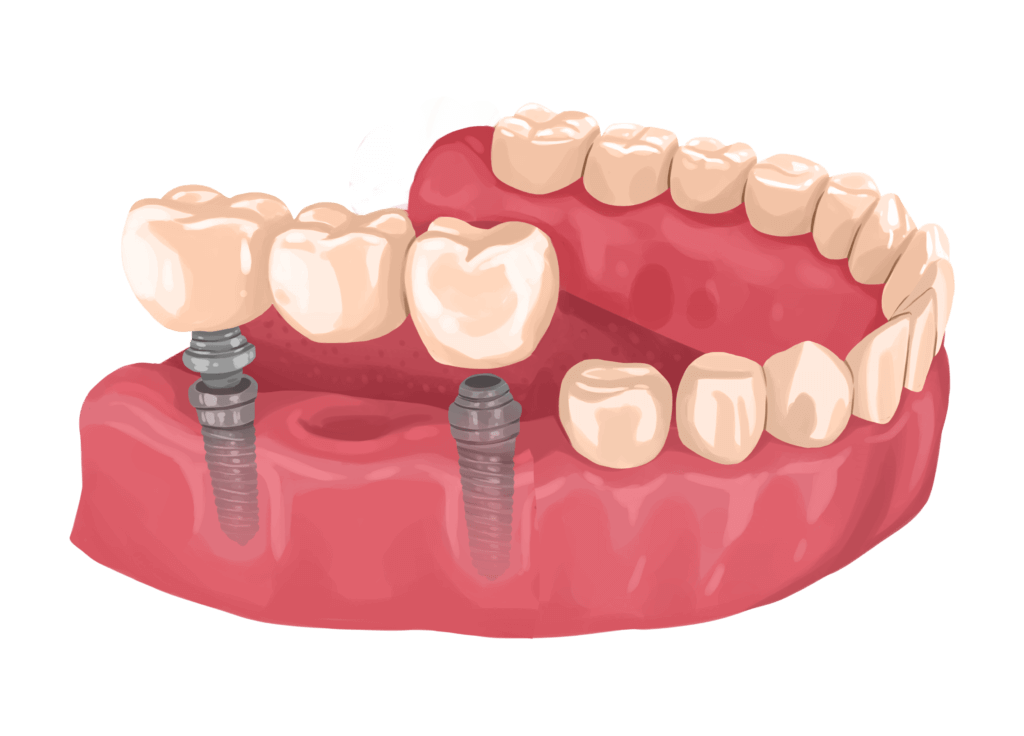 Implant Bridges Multi Unit Restorations - Implant Dental Lab - World Dental Lab